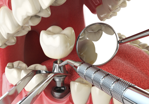 Dental Implants