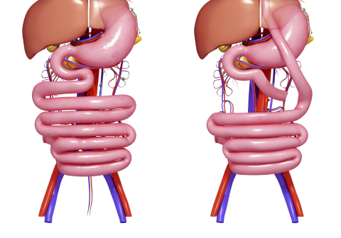 Sleeve Gastrectomy